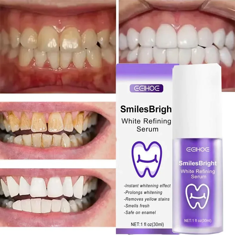 Tanden Reiniging Whitening Tan - Teeth Whitening In Korea recensie en prijs