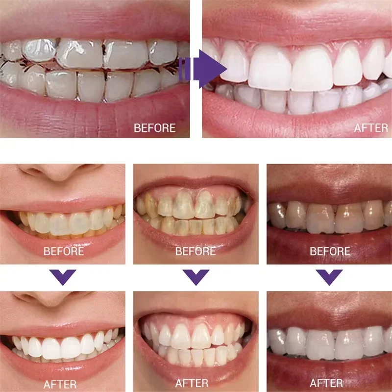 Tanden Reiniging Whitening Tan - Teeth Whitening In Korea recensie en prijs