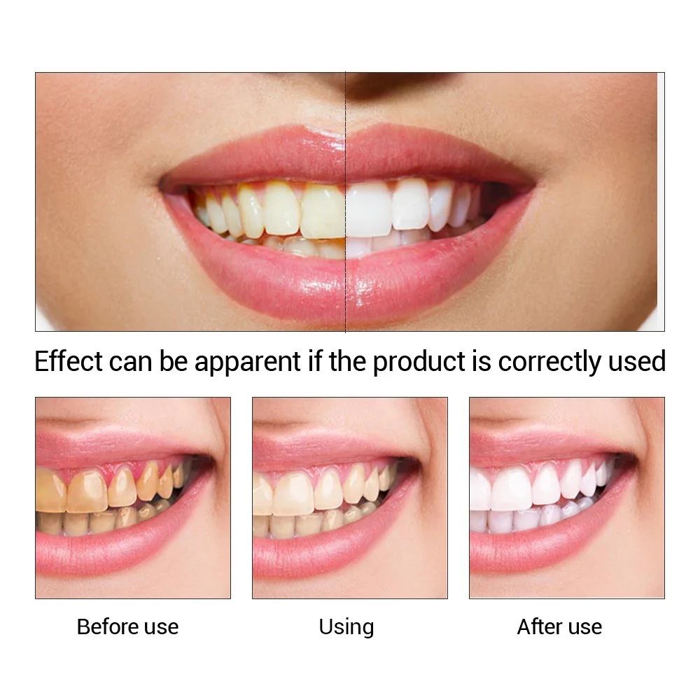 Fteenply Tanden Whitening Esse - Teeth Whitening Q&M recensie en prijs