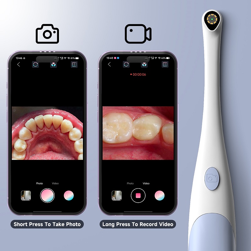 Orale Endoscoop Camera 1440P F - Teeth Whitening Video recensie en prijs