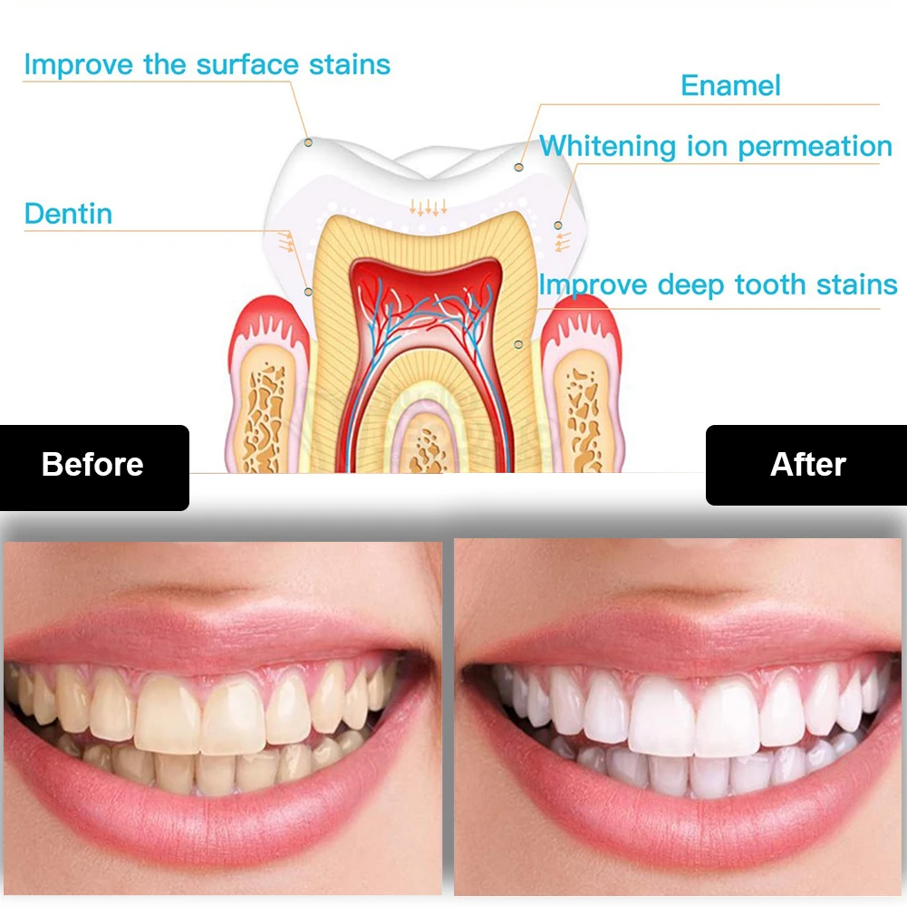 Tandheelkundige Tanden Whiteni - Teeth Whitening Laser recensie en prijs